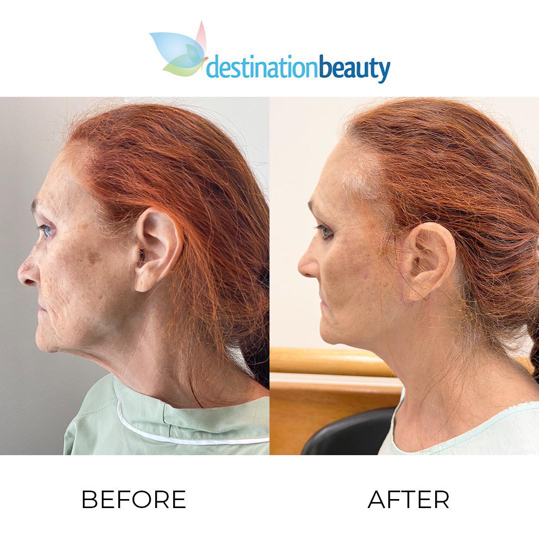 Lorae is now looking 15 years younger after facelift surgery in Thailand Destination Beauty